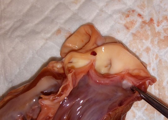 28. Výstup aorty z levé komory, semilunární chlopeň