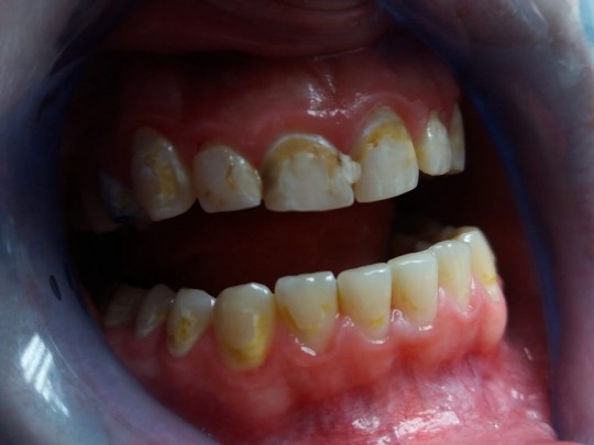 8. Demineralization after braces