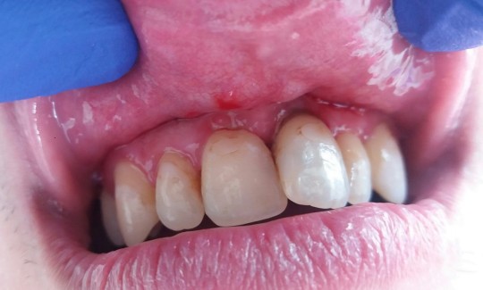 9. Gingivitis