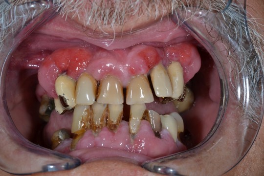 10. Periodontitis and hyperplastic gingivitis