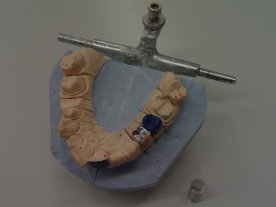 4. A premolar made from a metal alloy