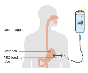 14. Perkutánní endoskopická gastrostomie