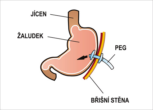 15. Perkutánní endoskopická gastrostomie