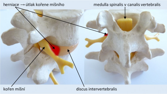 15. Herniace meziobratlové ploténky