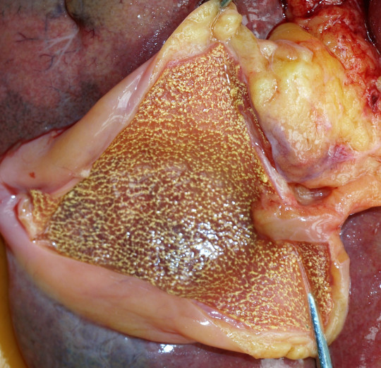 8. Cholesterolóza žlučníku.