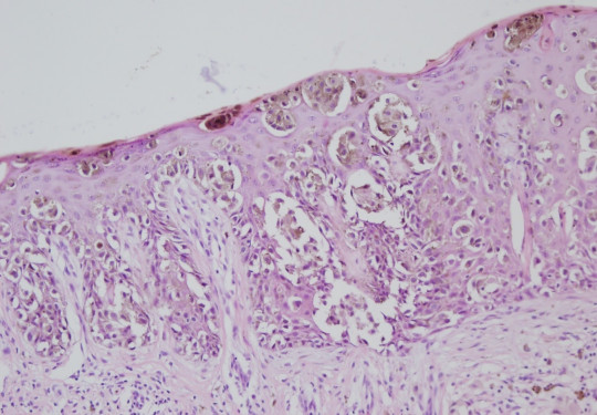 16. Histologický preparát – melanom.