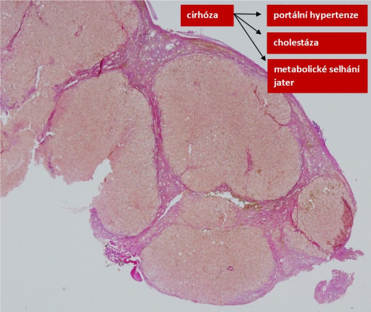 18. Histologický preparát – cirhóza jaterní.