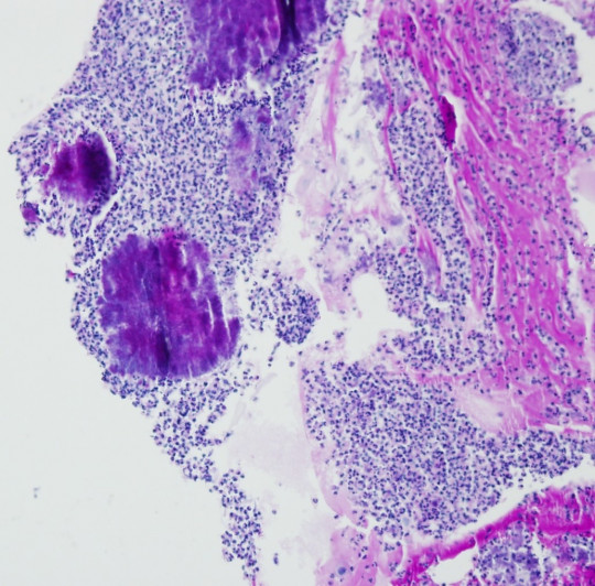 83. Histologický preparát – aktinomykóza.