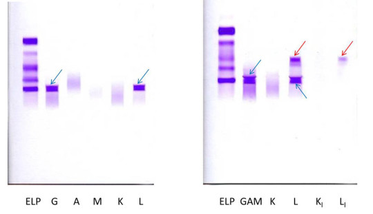 Průkaz monoklonálního proteinu IgG lambda (modré šipky) a volných lehkých řetězců lambda (červené šipky) imunofixační elektroforézou bílkovin krevního séra (obrázek vlevo) a moči (obrázek vpravo). ELP = elektroforéza; G, A, M, K, L = naneseny protilátky proti IgG, IgA, IgM a lehkým řetězcům κ a λ; Kl a Ll = naneseny protilátky proti volným lehkým řetězcům κ a λ